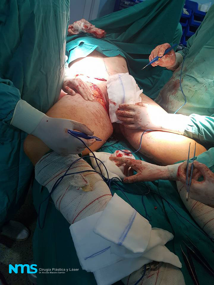 Cirugia reduccion barriga cadiz